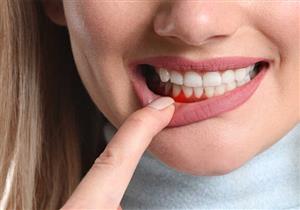 التهاب اللثة.. الأسباب والأعراض والوقاية والعلاج